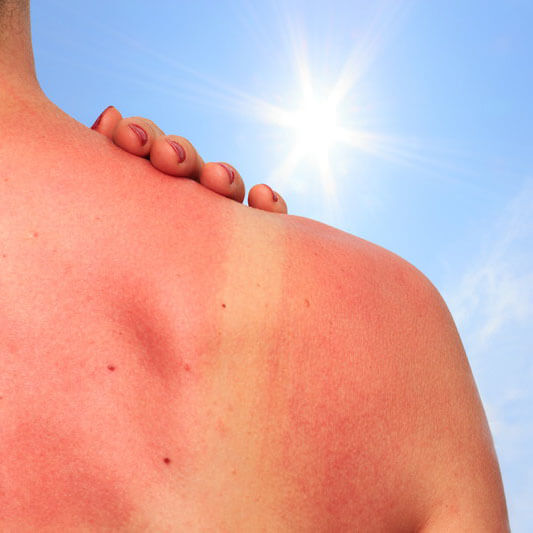日焼けで黒くなった肌の改善なら美容皮膚科のUV対策治療がおすすめ